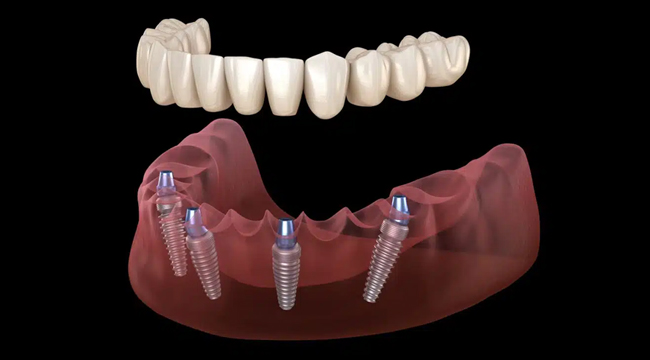Dental implant prosthetic teeth and titanium fixtures on jawbone model for restoration.