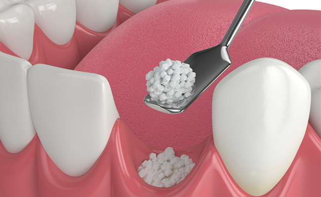 3D dental illustration showing bone graft material being placed between teeth in gum tissue.