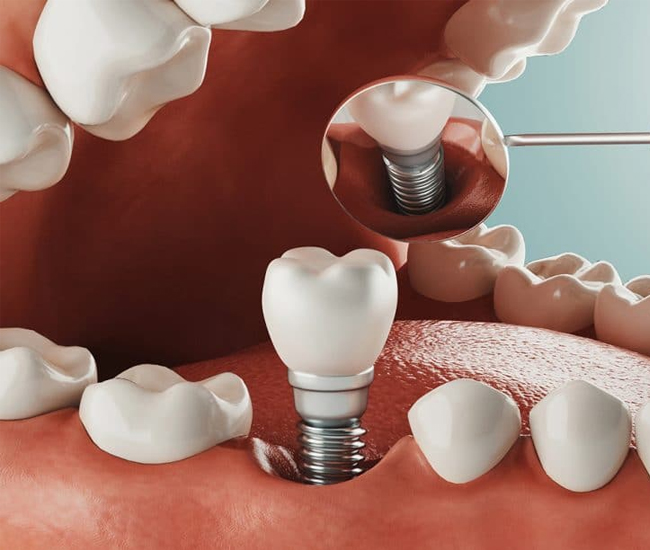 Dental implant illustration showing prosthetic tooth component in gum tissue with surrounding natural teeth.