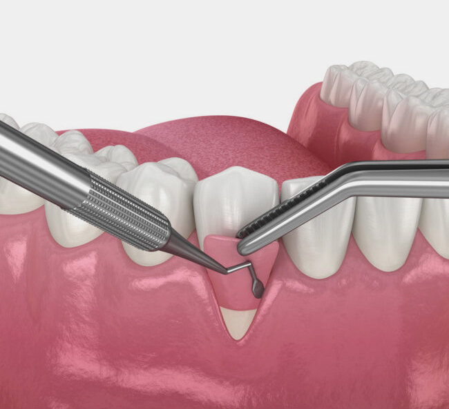 Dental tools performing gum grafting surgery on patient's gum tissue and teeth.