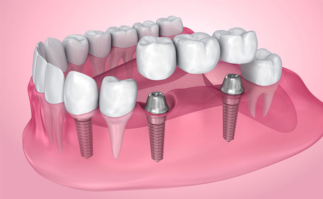Dental implants model showing multiple tooth replacements on pink gum base with metallic implant posts.