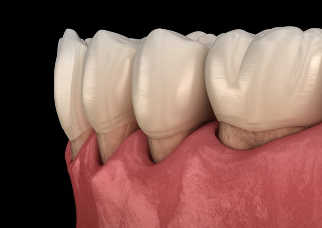 Dental crown restoration showing tooth implant with pink gum tissue on black background.