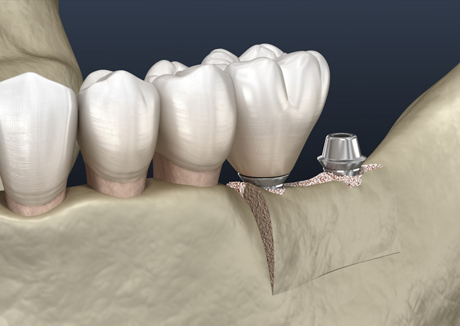 Dental implant abutment positioned next to ceramic tooth restorations on model jaw.