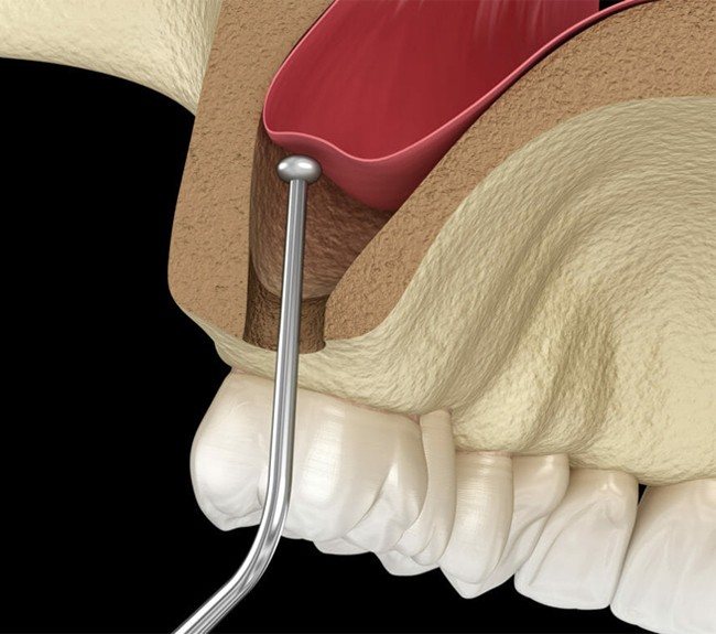 Dental implant surgical procedure showing probe instrument examining jawbone structure during implantation.