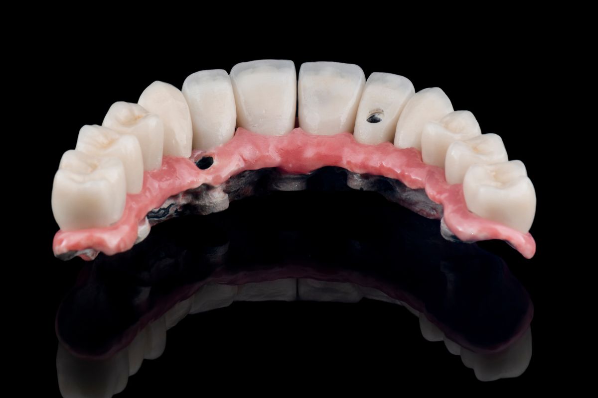 All-on-4 Implants