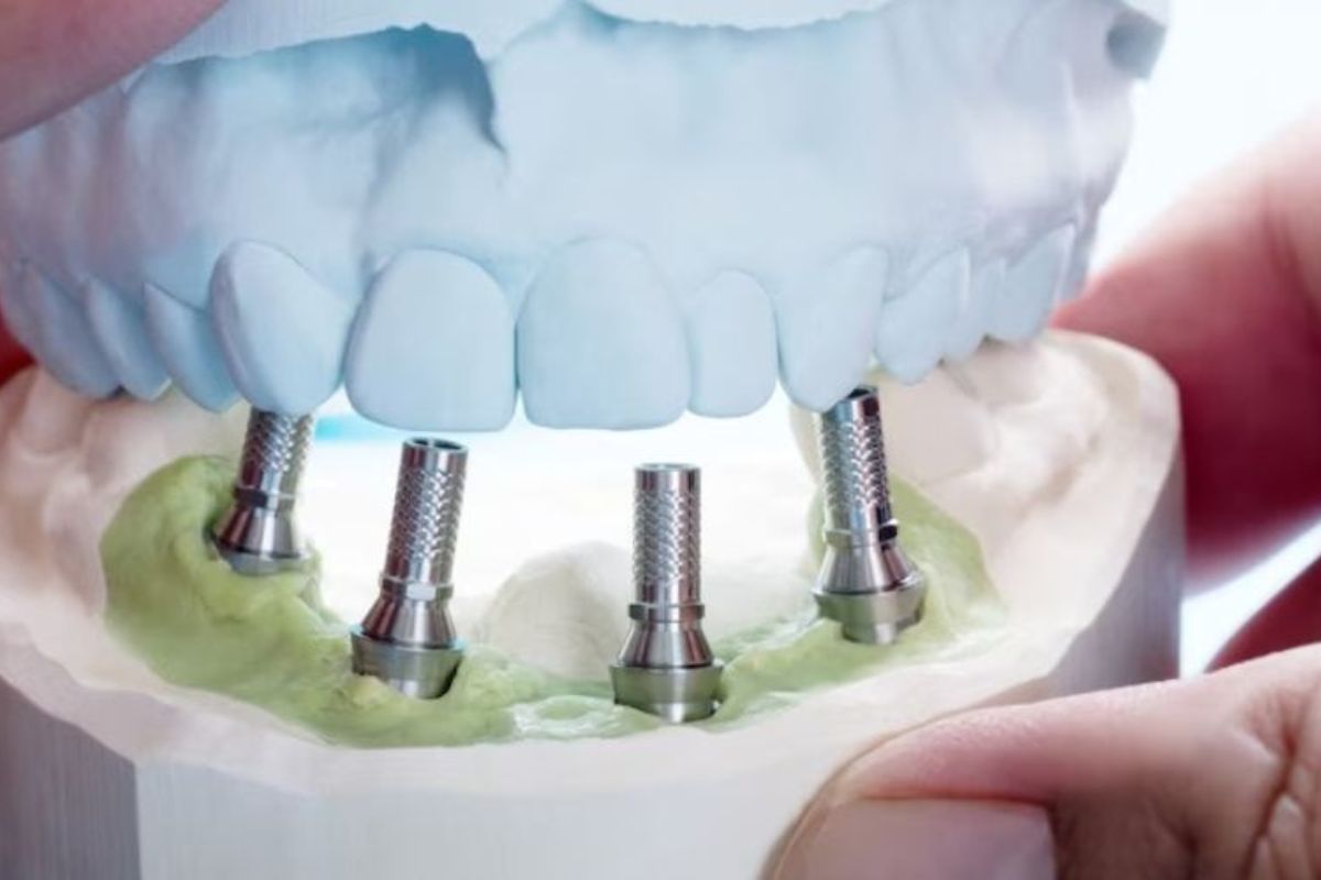 Dental implant model showing four titanium implants in jawbone with prosthetic teeth.
