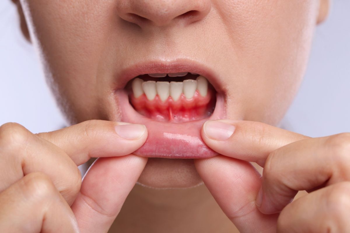 Preventing Gum Disease