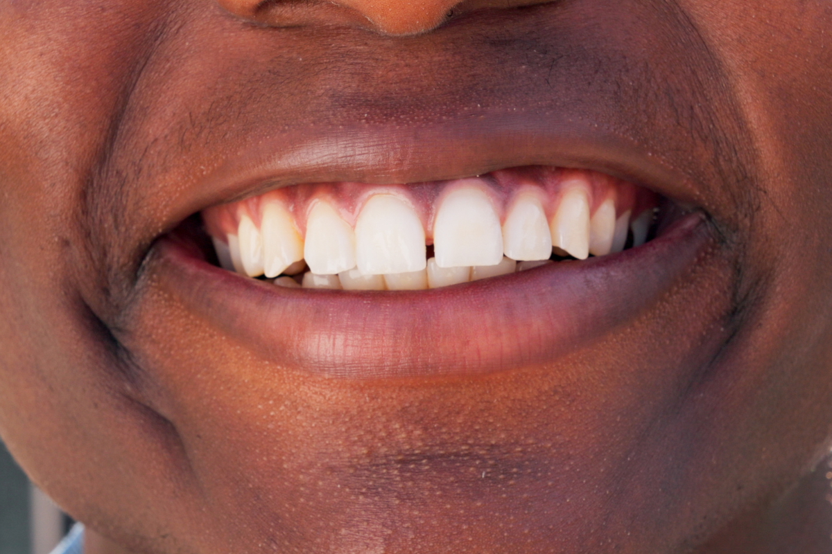 wisdom teeth removal McKinney