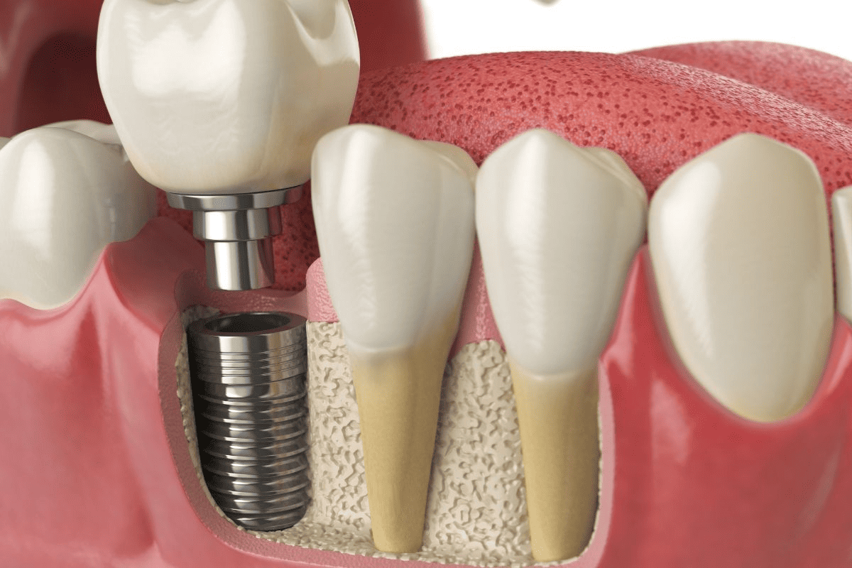 McKinney Dental Implants