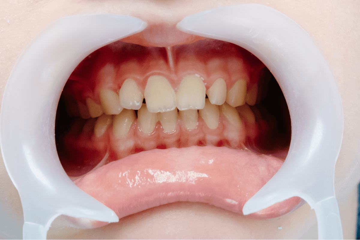 gum disease treatment McKinney